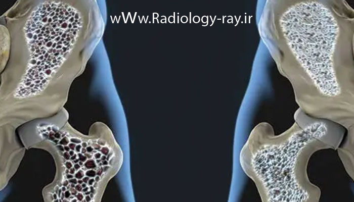 تشخیص پوکی استخوان با تست سنجش تراکم استخوان